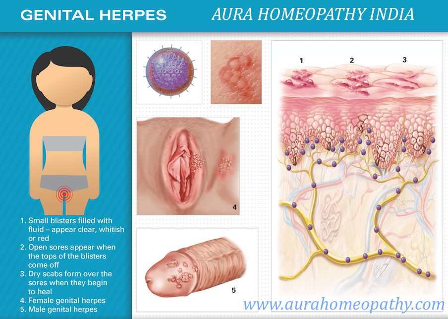 Genita Herpes Homeopathic Medicine